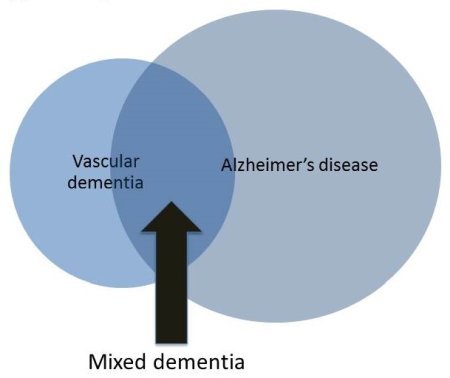 Cos'è la demenza mista?
