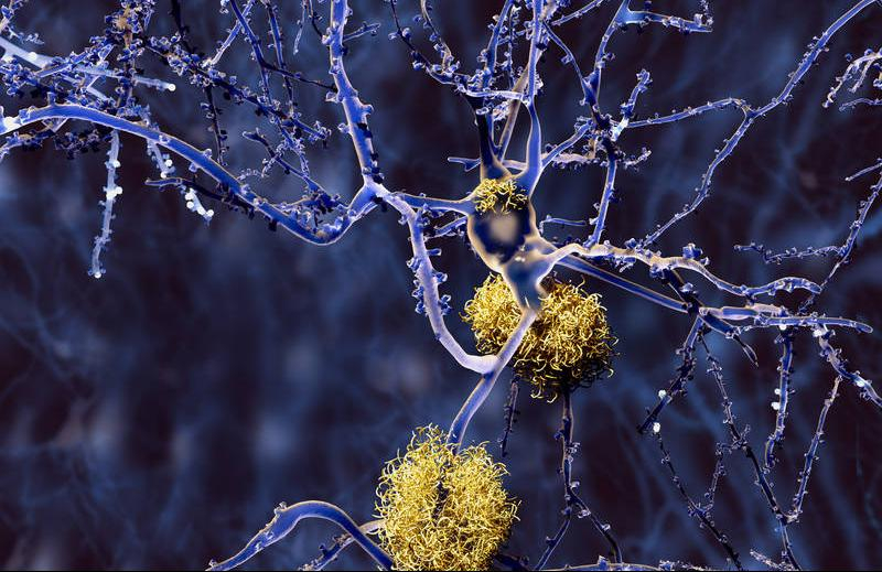 Neuron mit Amyloid plaques