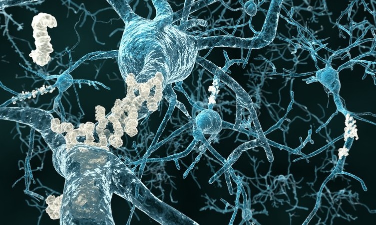 L'Alzheimer sta lentamente svelando i suoi segreti, e i 'geni di rischio' sono solo un pezzo del puzzle