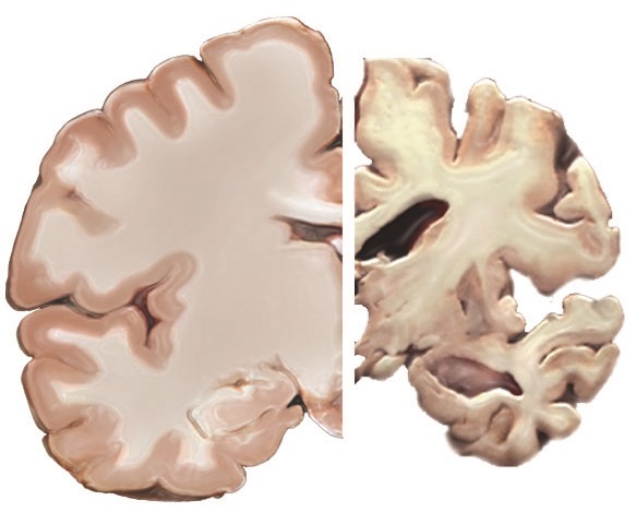 Normal vs Alzheimer Brain NIH