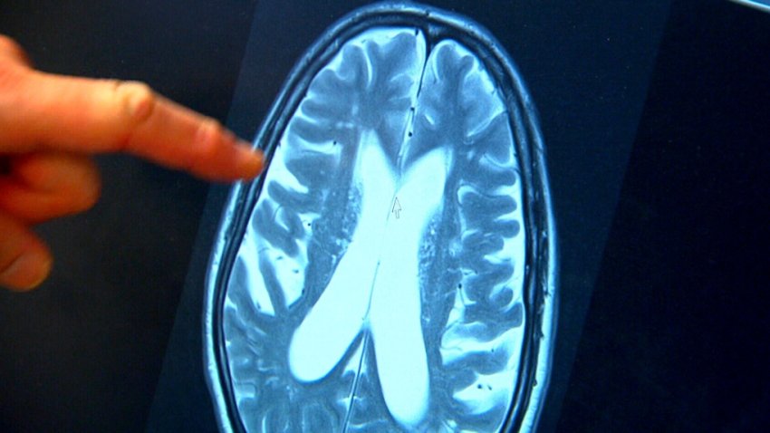 Idrocefalo a pressione normale idiopatico: non è Alzheimer
