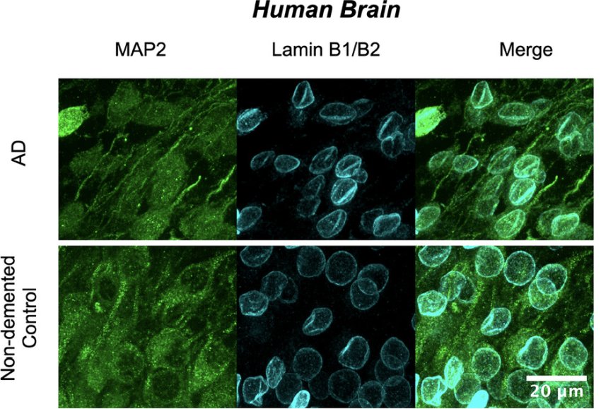 Nuclear lamina invaginations in human cortical AD neurons in vivo