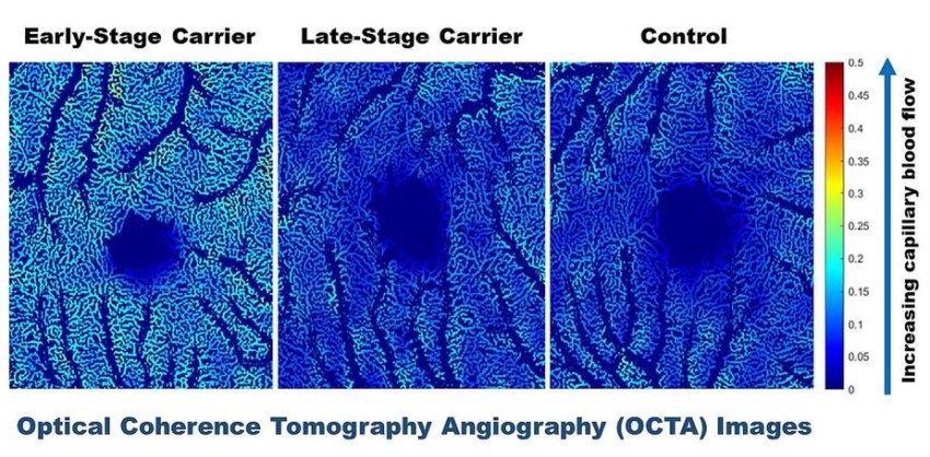 OCTA images of retinal capillaries