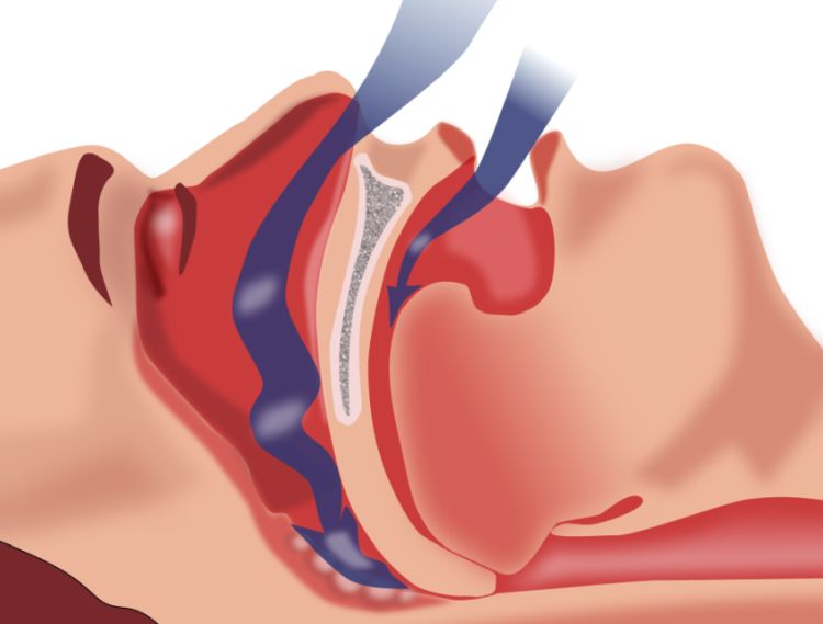 Obstruction ventilation sleep apnea by Habib Mhenni Wikimedia public domain