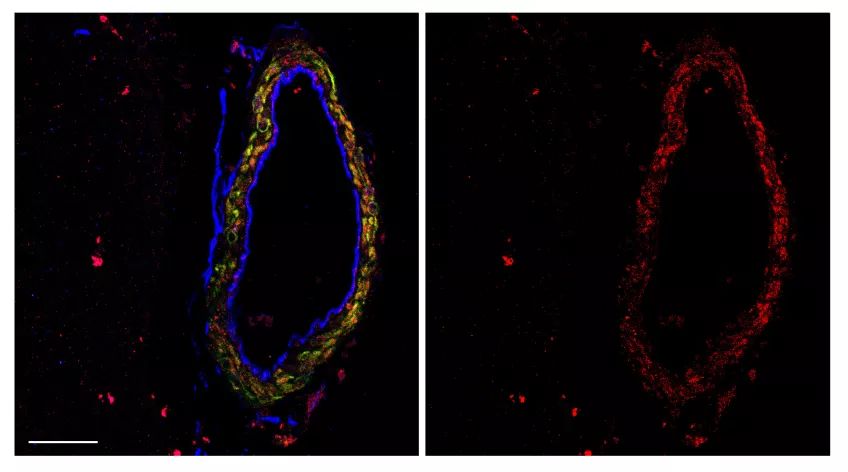 Ozen et al Acta Neuropatologica