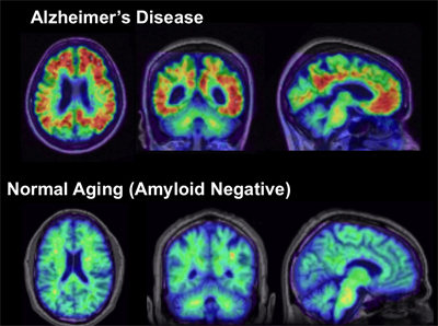 PET Scans AD Vs Normal Aging
