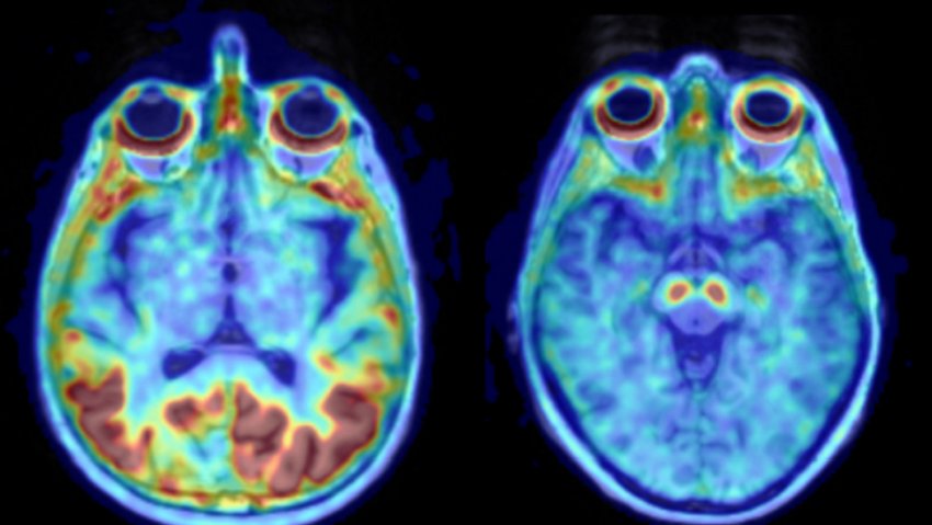 Patological tau uptake left healthy brain right