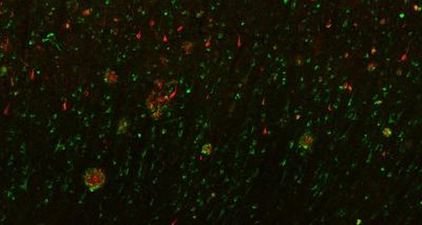 Phospholipase D3 green neuritic plaques and neurofibrillary tangles red