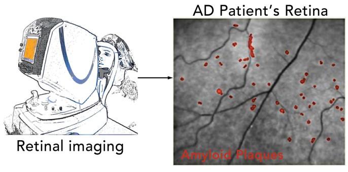 Scansione non invasiva della retina può migliorare la diagnosi precoce di AD