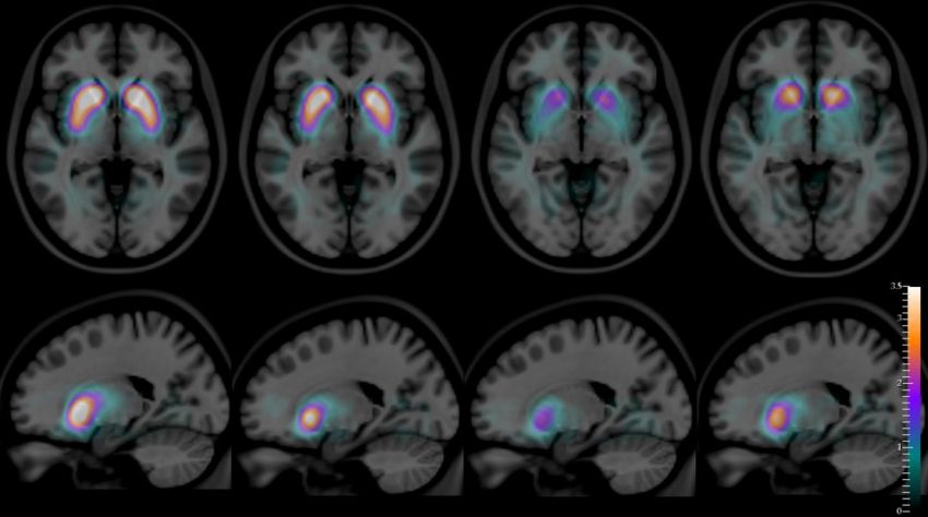 SPECT images of axial slice top row and sagittal slice bottom row of human brain