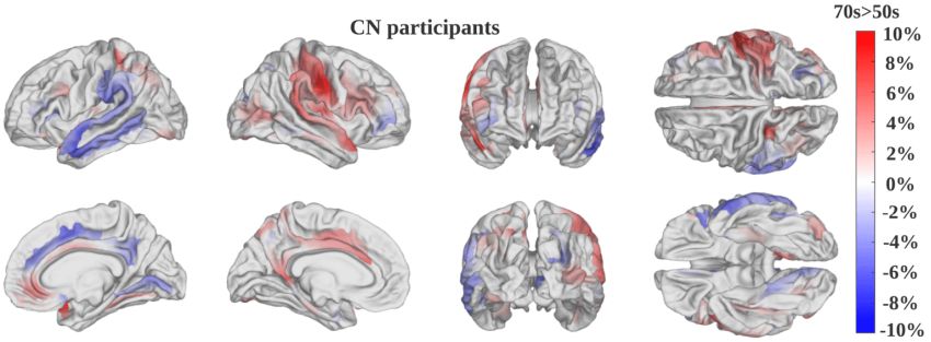 Mappa di salienza prodotta dal nuovo modello AI con la differenza media nella salienza tra partecipanti cognitivamente normali sui 50 anni (in blu) e quelli sui 70 (rosso). (Fonte: USC/Chenzhong Yin)