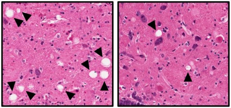 Salvare i neuroni può essere una strada per trattare l'Alzheimer