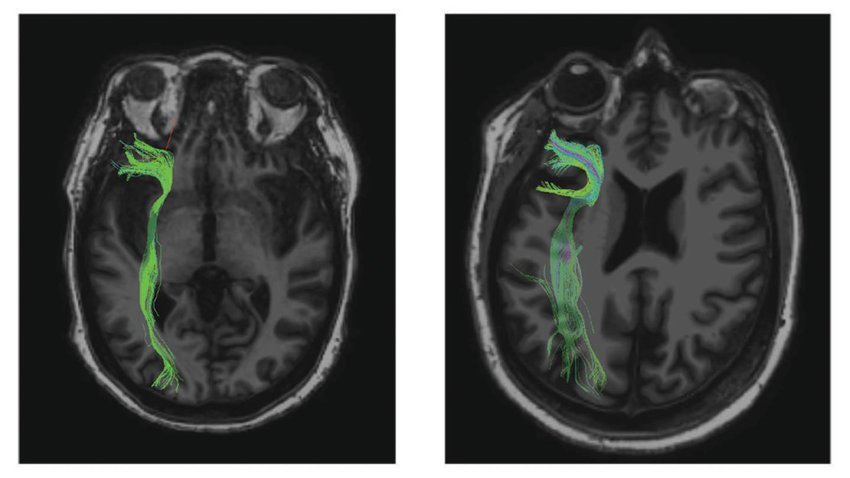 Scan of brains with impaired and normal connections