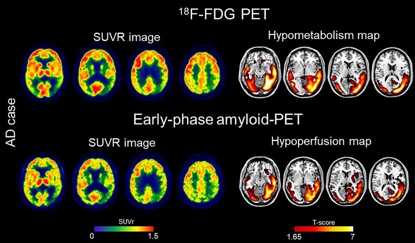 The comparability of early phase amyloid PET and FDG PET images at the single subject level