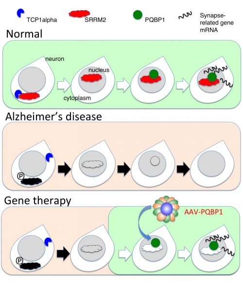 Theory of Gene Therapy by AAV PQBP1