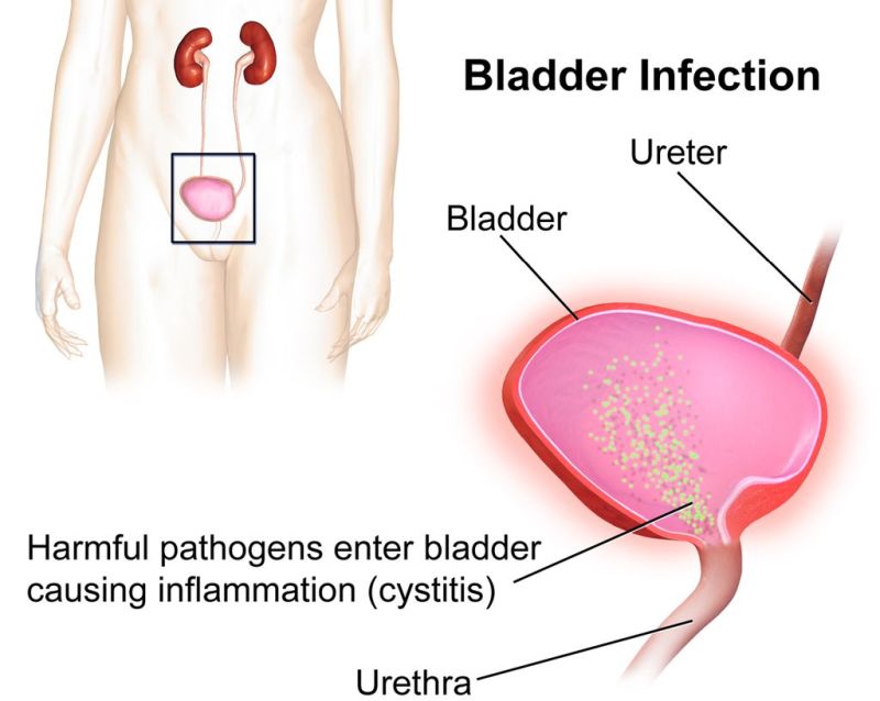 Urinary tract infection bladder infection by BruceBlaus on Wikimedia