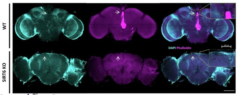 Vacuolization differences in D melanogaster brains suggesting neurodegeneration