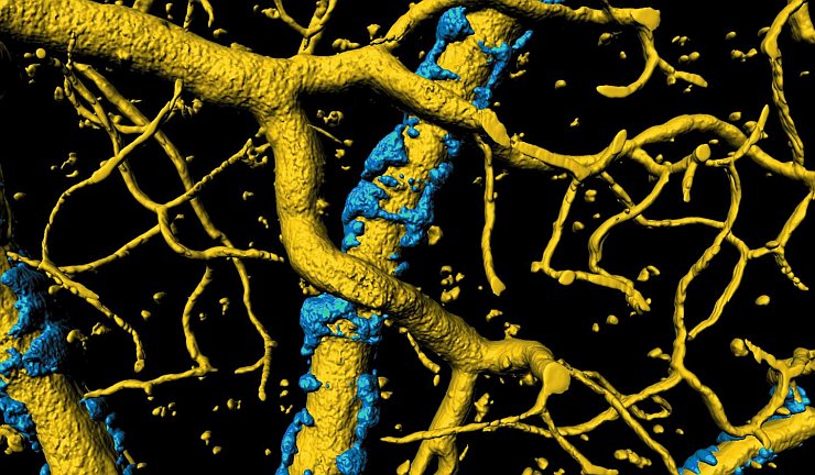 Le placche amiloidi interrompono anche il sangue diretto ai neuroni
