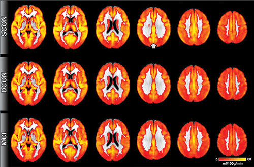 Una tecnica MRI rileva prove di declino cognitivo prima della comparsa dei sintomi