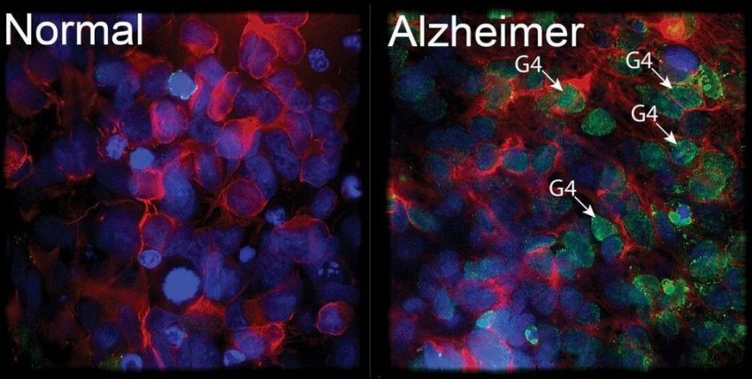 accumulation of G4 structures in Alzheimer neurons and healthy neuron