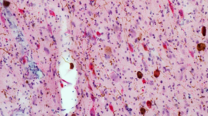 ad tissue with tau brown and neurons red