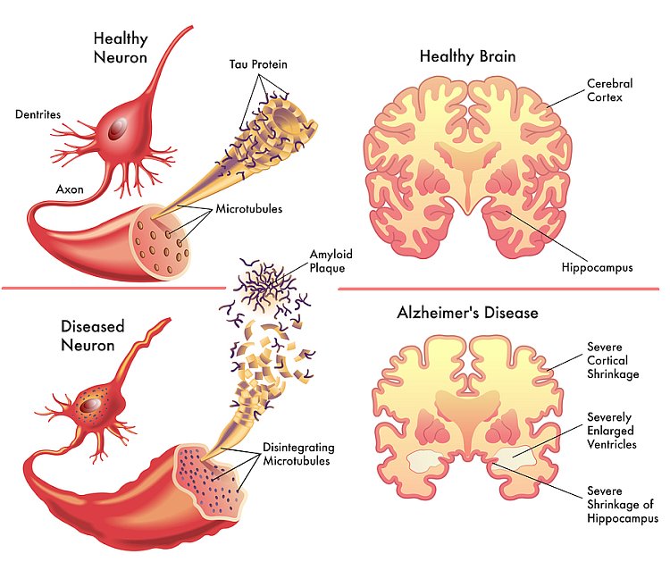Ricerca: l'Alzheimer inizia solo se e quando l'amiloide-beta provoca la fosforilazione della tau