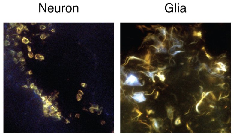 Le placche dell'Alzheimer colpiscono le varie cellule cerebrali in modo diverso