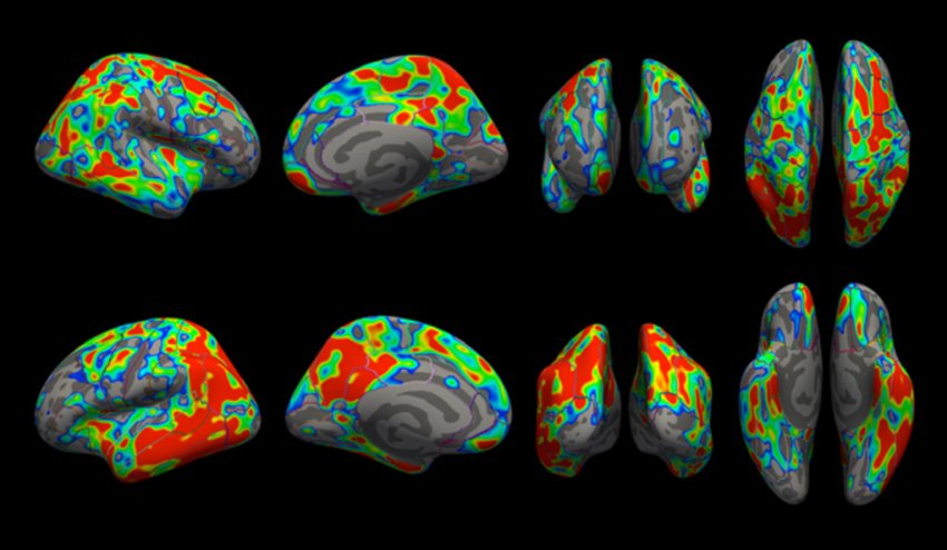alzheimer brain scans