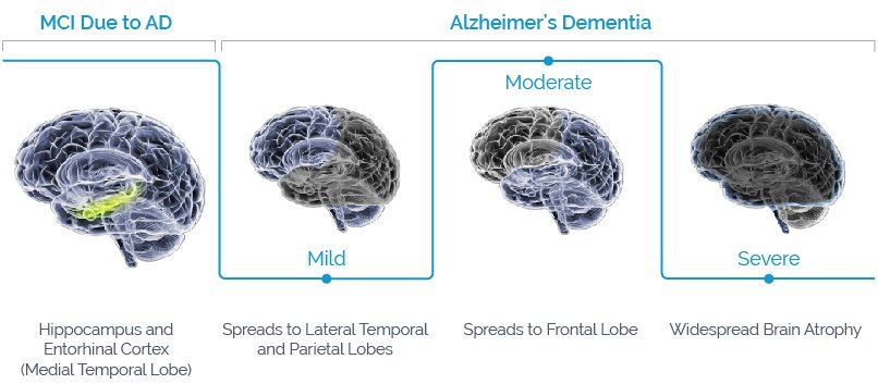 alzheimer progress diagram