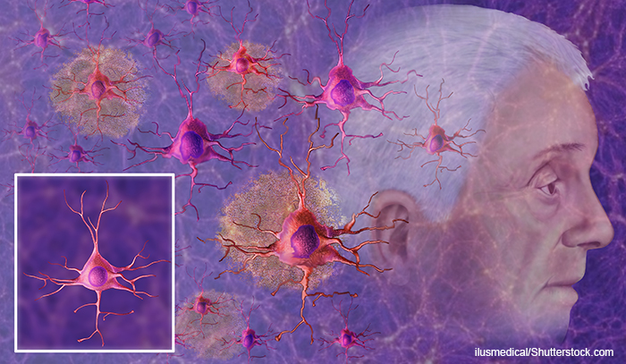representative of Alzheimer illustration, can be seen in neurons of fibrillary tangles degenerative state.