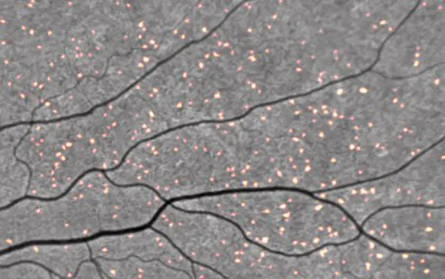 amyloid retina