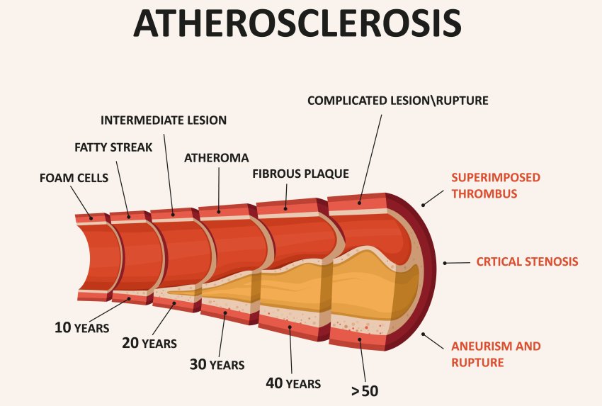 atherosclerosis shutterstock