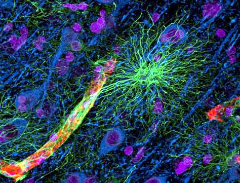Gli astrociti del cervello collegati ancora all'Alzheimer
