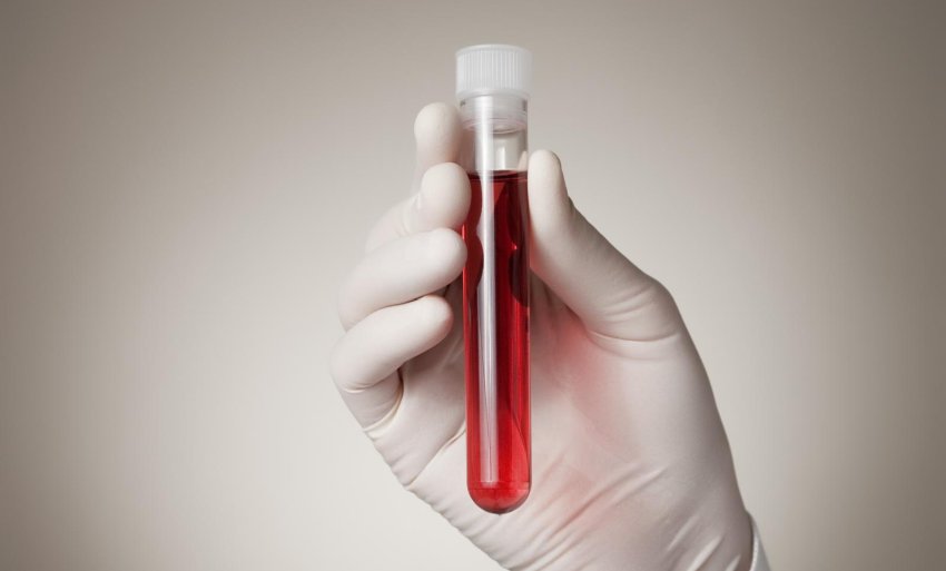 Sviluppato in Canada nuovo esame del sangue per rilevare la demenza