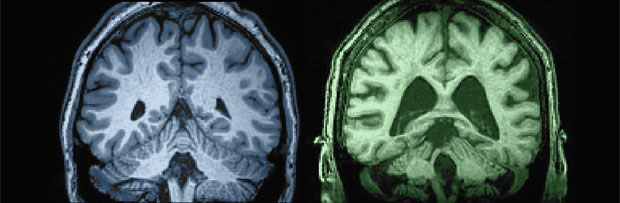 brain aging 27 vs 87 years old