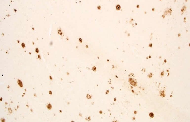 brain amyloid plaques brown