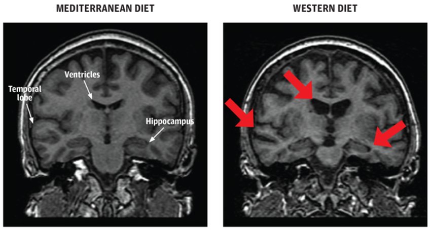 brain comparison med vs western diets