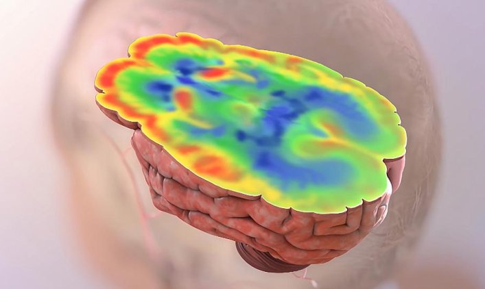 Quantità elevata di glucosio del cervello può significare Alzheimer più grave