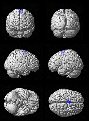 La musica attiva aree del cervello prese di mira dall'Alzheimer