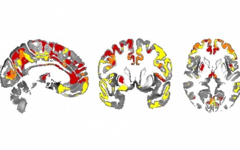 brain scans for iron accumulation