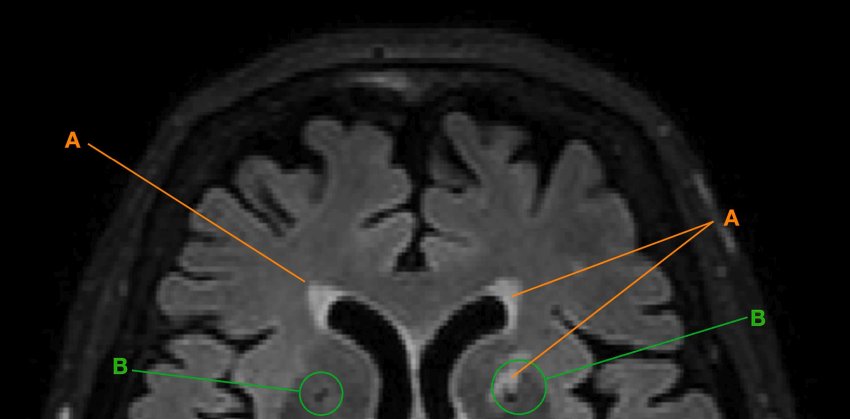 Pre and post menopausal brain scan