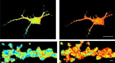 Alzheimer: come alterano la funzione dei neuroni le placche di amiloide