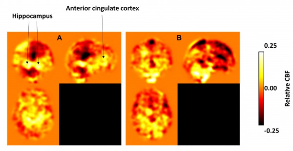 cerebral blood flow after 1 year of A exercise and B no exercise