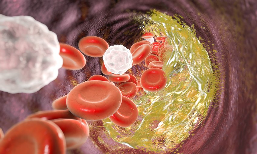 cholesterol narrowing artery