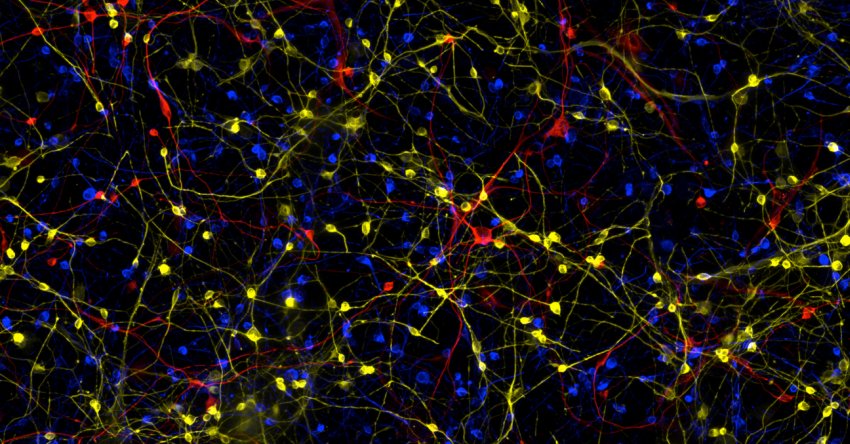 composite image of induced neurons in Alzheimer