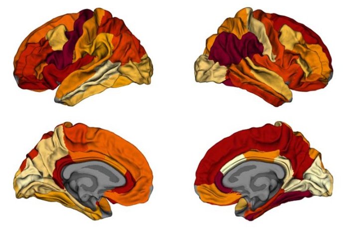 cortical thickness in obesity and Alzheimer