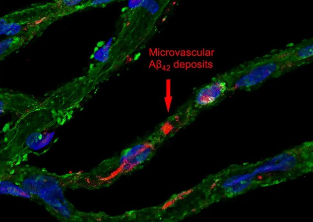 degenerated pericytes green with accumulation of amyloid beta red in AD retina