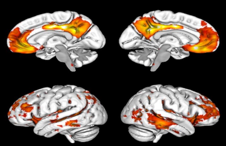 Nuova ricerca mostra dove appaiono i primi segni di Alzheimer nel cervello