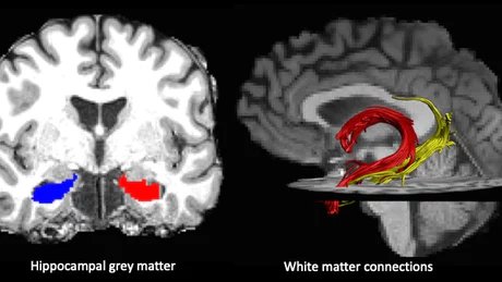 grey and white matter