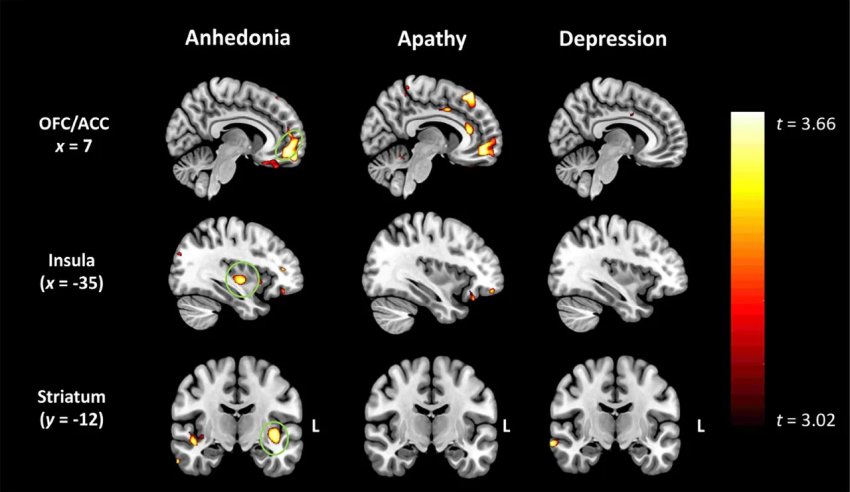 grey matter intensity decreases related to anhedonia apathy depression